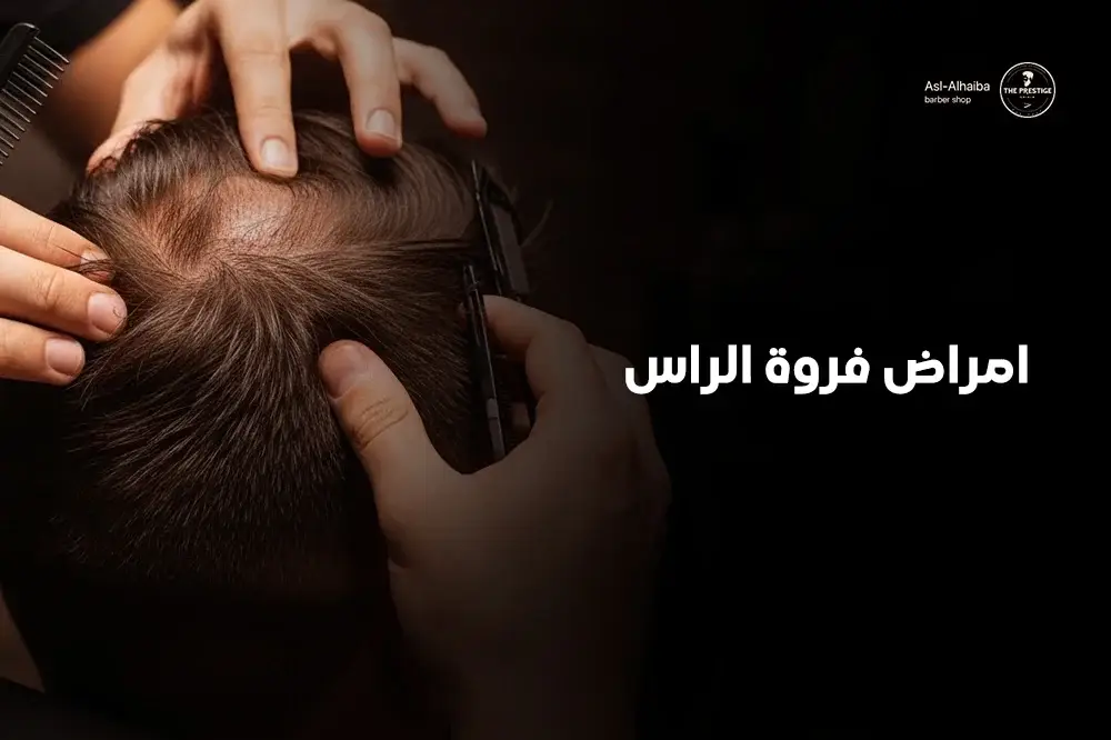 امراض فروة الراس